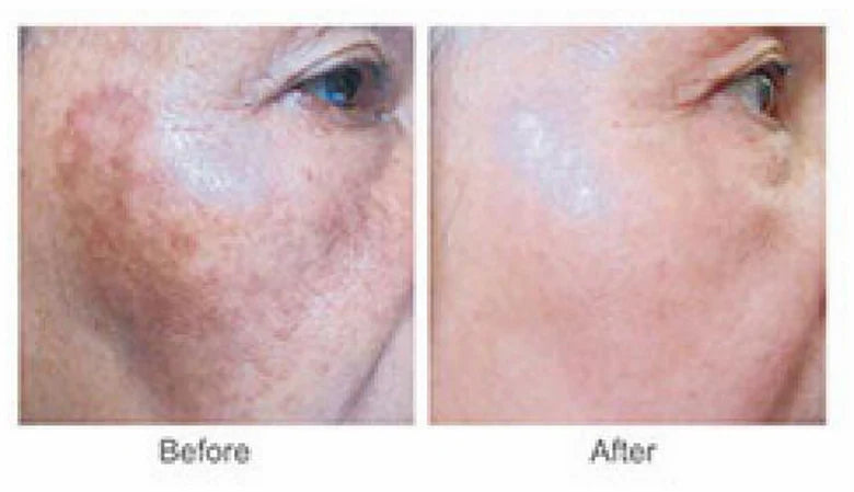 Cindella Whitening Treatment 1200mg - 10 vials/Box